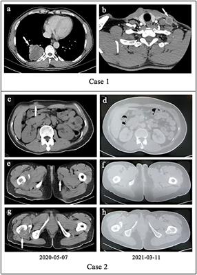 Case Report: Early Distant Metastatic Inflammatory Myofibroblastic Tumor Harboring EML4-ALK Fusion Gene: Study of Two Typical Cases and Review of Literature